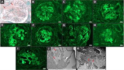 ANCA-associated glomerulonephritis and lupus nephritis following COVID-19 vaccination: a case report and literature review